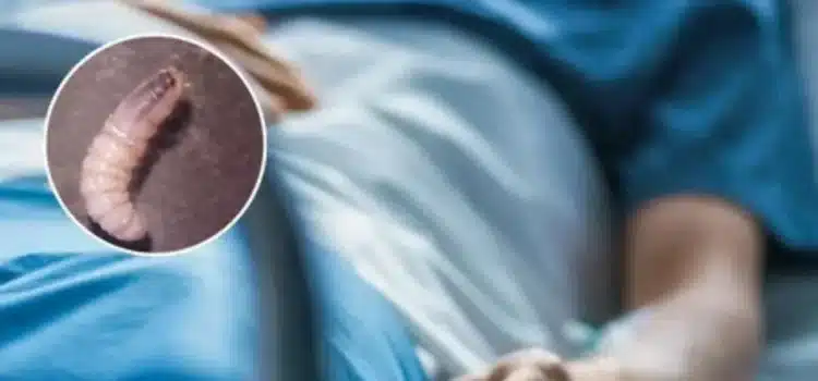 Suman cuatro casos de miasis por gusano barrenador en humanos en Chiapas