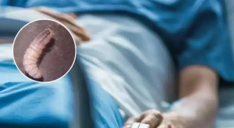 Suman cuatro casos de miasis por gusano barrenador en humanos en Chiapas