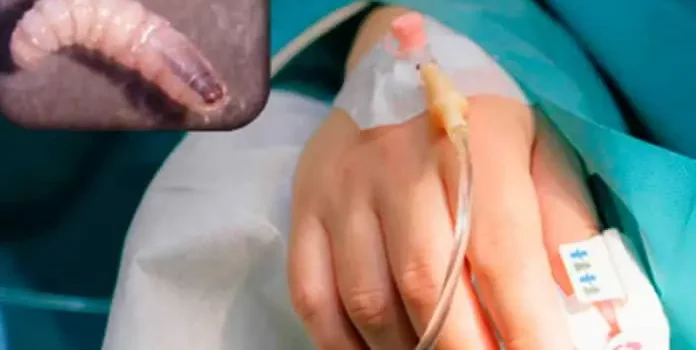 Confirman 33 casos de miasis en humanos en Chiapas y Campeche